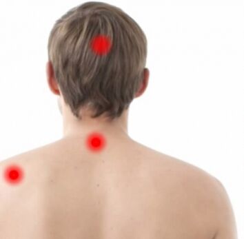 Osteokondrózis fókuszai