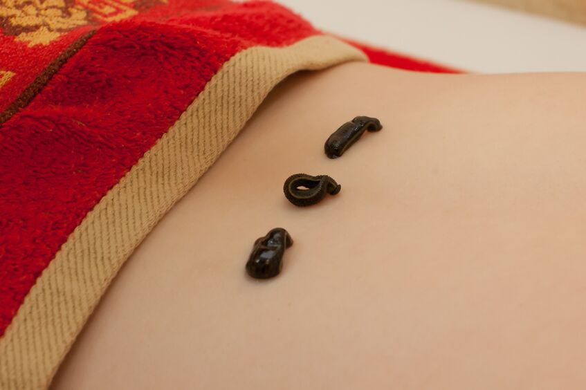 piócák a hát alsó részén osteochondrosissal