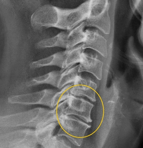 méhnyak osteokondrózis